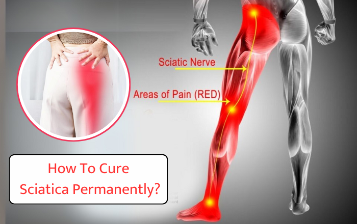 How To Cure Sciatica Permanently?