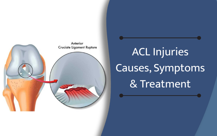 ACL Injuries: Causes, Symptoms, and Treatments