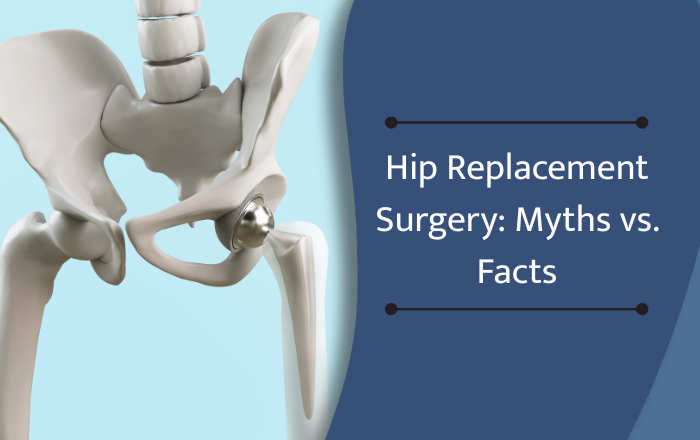 Hip Replacement Surgery Myths vs. Facts